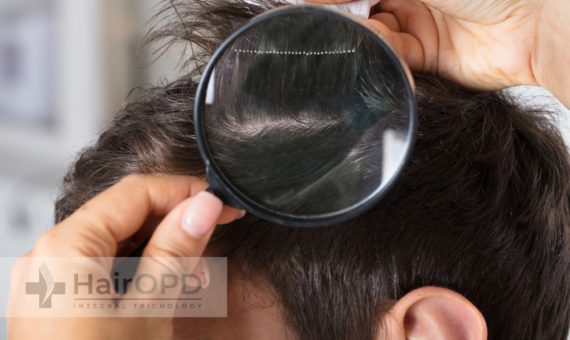 best hairloss treatment in india