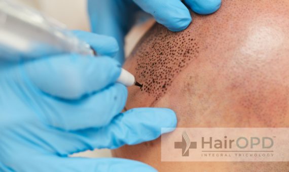 scalp micro pigmentation in india