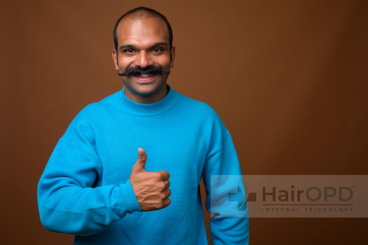 its okay to be bald male baldness treatment in india